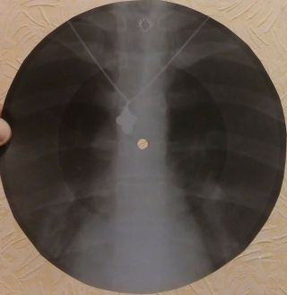 QUEEN - SON AND DAUGHTER - USSR GEORGIAN X - RAY ROENTGEN RIBS BONES RECORD 3