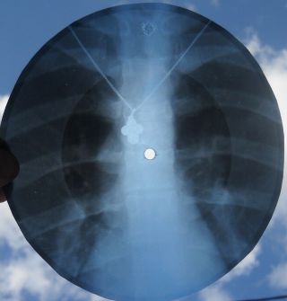 QUEEN - SON AND DAUGHTER - USSR GEORGIAN X - RAY ROENTGEN RIBS BONES RECORD 4