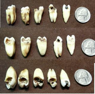 5 Real Human Teeth Severe Decay,  Filling Dental Student Oddities Cavities