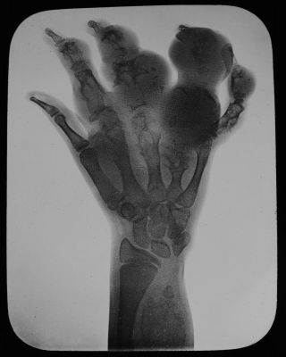 Magic Lantern Slide Xray Or Shadowgram Swollen Human Hand C1900 Medical Photo