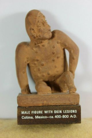 Mexican Mayan Aztec Clay Pottery Statue Male Figure With Skin Lesions